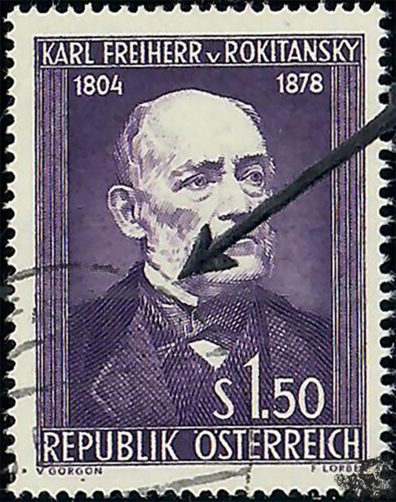Österreich 1954 o - 1,50 S - 150. Geb. Karl Freiherr v. Rokitansky mit Plattenfehler